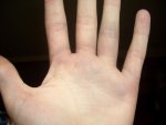 Bruised Hand.JPG